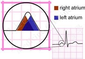 Normal P wave formation showing sequential right-to-left atrial depolarization