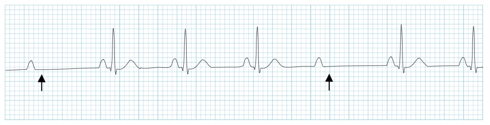 Mobitz II with constant PR interval and sudden dropped QRS
