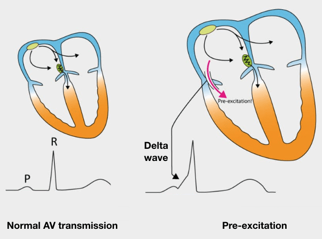 Wolff-Parkinson-White syndrome with short PR and delta wave