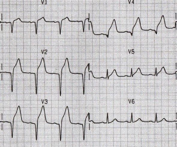 Anterior Q waves STEMI