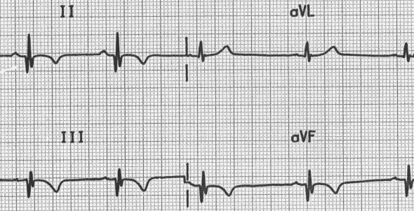 Q waves with old inferior MI