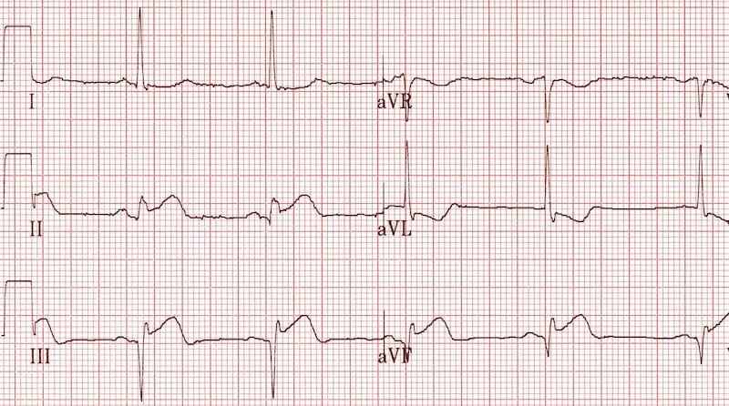 Inferior Q waves with STEMI