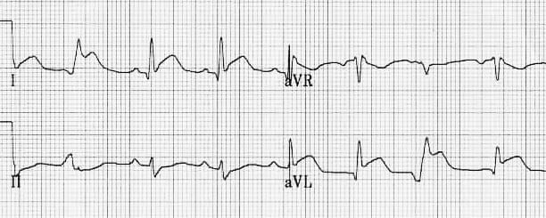 Lateral Q waves with STEMI
