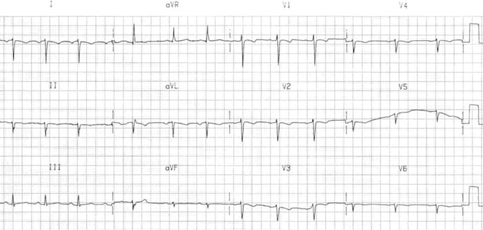 Dextrocardia ECG pattern