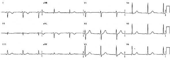 Left arm/right arm lead reversal