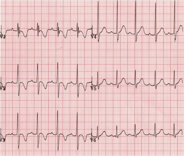 Normal paediatric ECG showing dominant R in V1