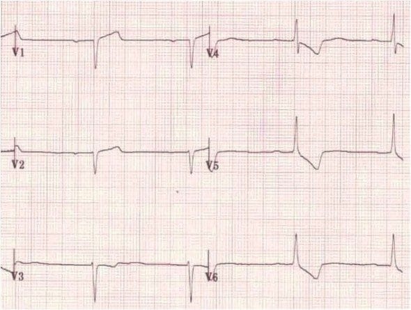 Poor R wave progression ECG