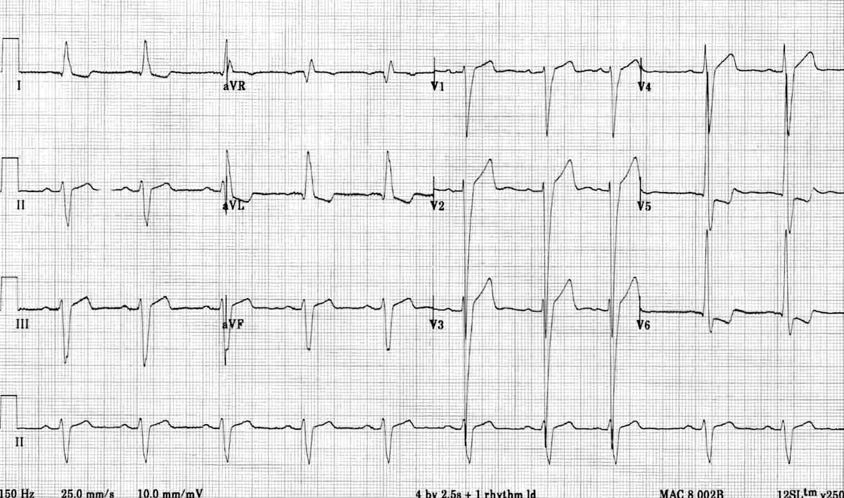 Severe LVH with massive S waves