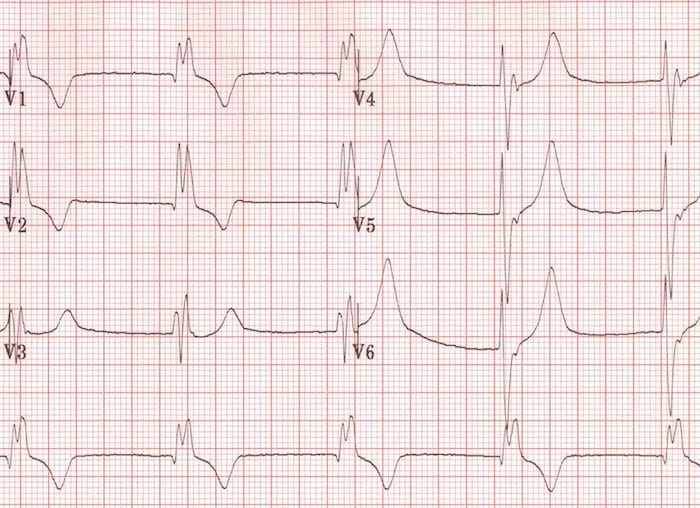 RBBB with slurred S waves
