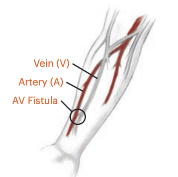 Arteriovenous (AV) fistula showing surgical connection between artery and vein