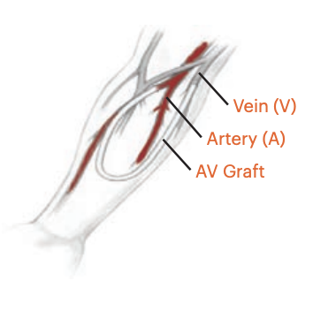 Arteriovenous (AV) graft showing synthetic conduit between artery and vein