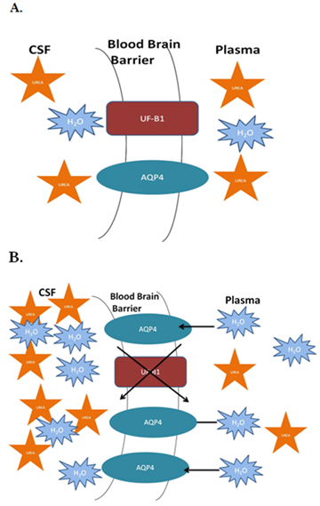 Dialysis disequilibrium syndrome diagram showing the reverse urea effect with high BUN in CSF, downregulated urea transporters, upregulated AQP4, and water movement into brain leading to cerebral edema