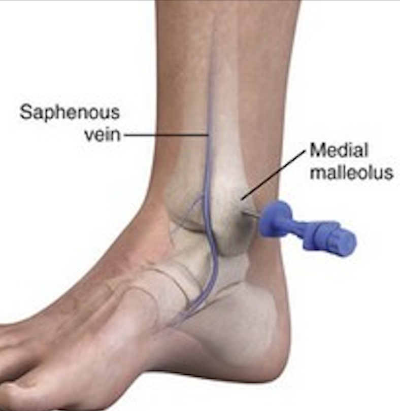 Distal tibia anatomy for IO insertion
