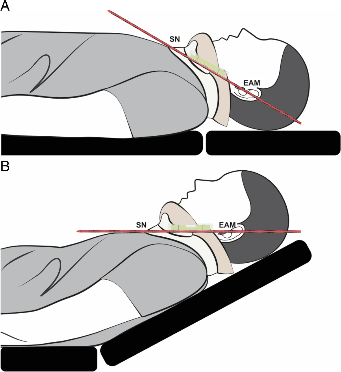 Ramped positioning for intubation