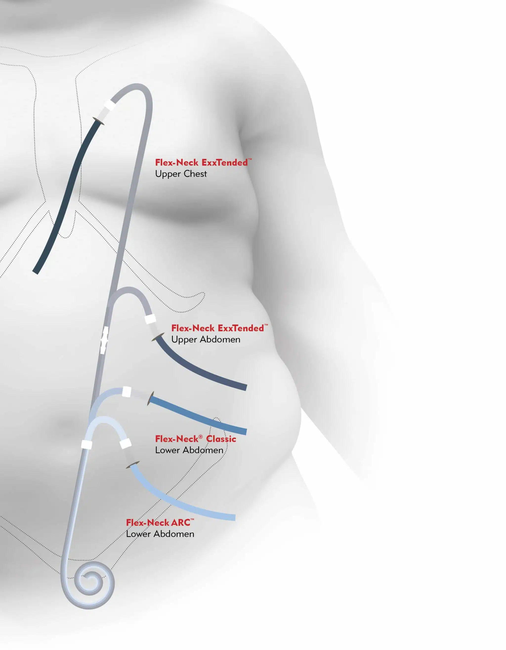 Illustration of PD catheter positions and exit-site options including standard lateral, downward exit, and presternal catheter