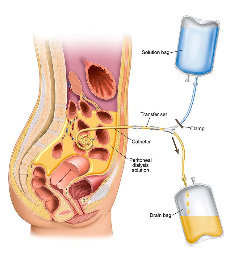 Patient education diagram showing abdominal PD catheter placement and exit site