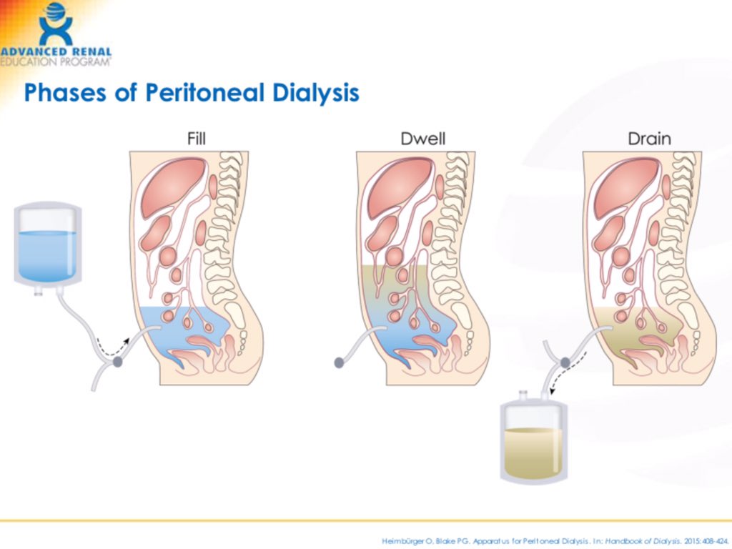 Three steps in peritoneal dialysis exchange: Drain, Fill, Dwell cycle diagram